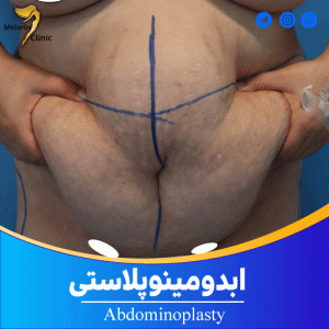 ابدومینوپلاستی، هزینه عمل لیفت شکم، هزینه عمل ابدومینوپلاستی، عوارض عمل ابدومینوپلاستی، بهترین متخصص ابدومینوپلاستی