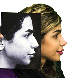 عمل بینی، عوارض عمل بینی، دکتر خداکرمی