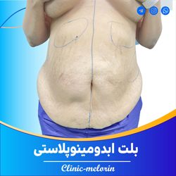 بلت ابدومینوپلاستی